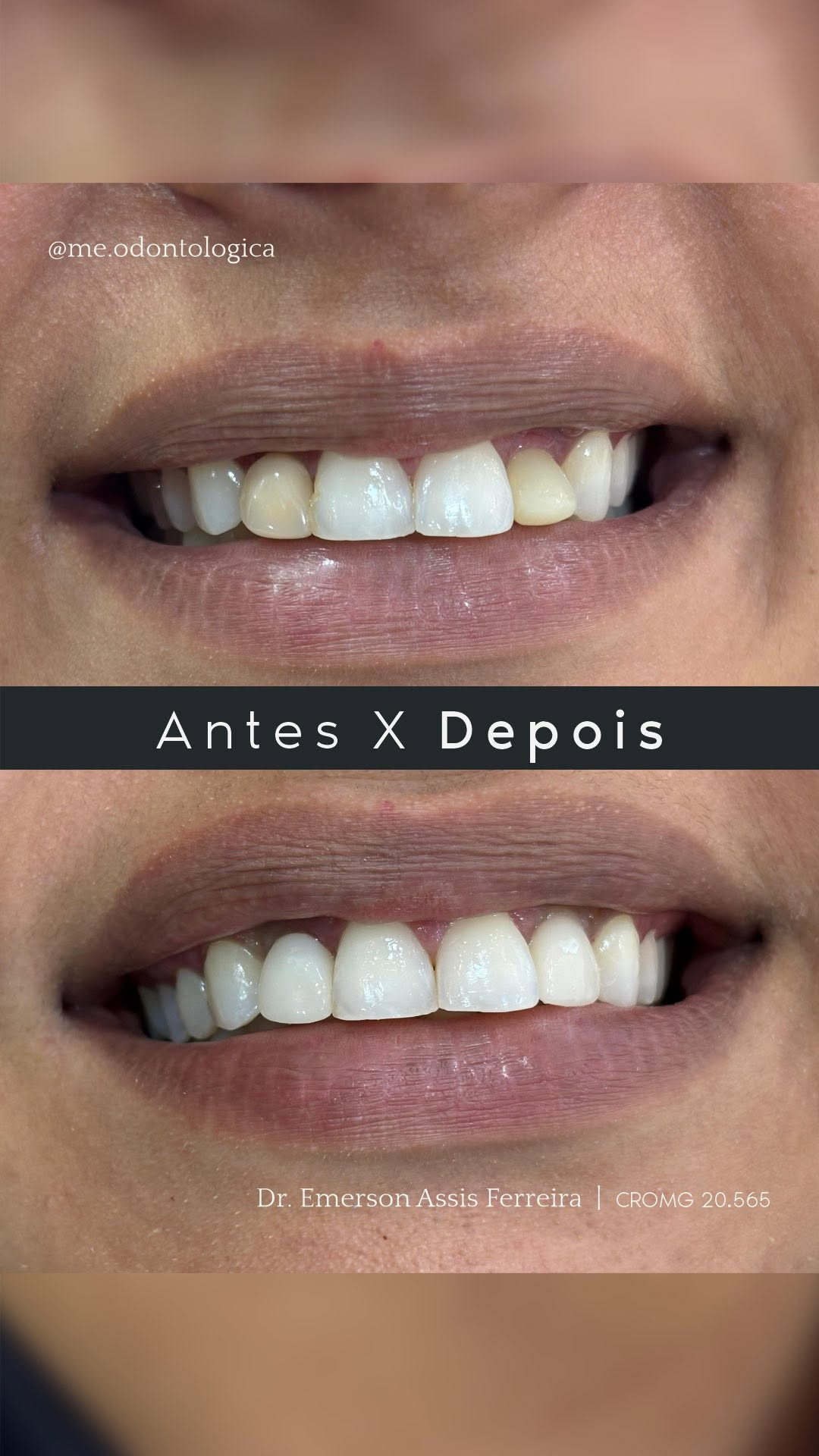 Reabilitação estética anterior — antes e depois com Dr. Emerson Ferreira